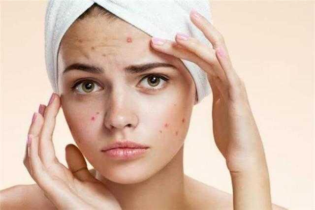 ماسكات طبيعية للتخلص من حب الشباب