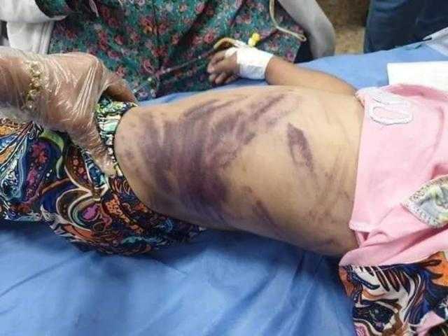 هبة.. مأساة طفلة دمياط عذبتها زوجة أبيها بالحرق والخنق