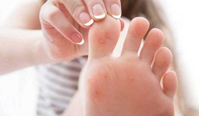 أسباب وطرق علاج عين السمكة