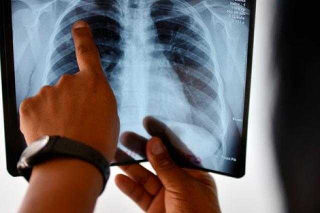 أعراض الالتهاب الرئوي والسل