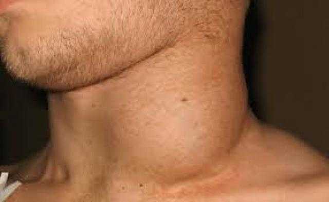 تعرف على أعراض ومراحل سرطان الغدد الليمفاوية