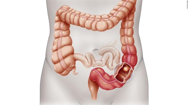 التهاب القولون