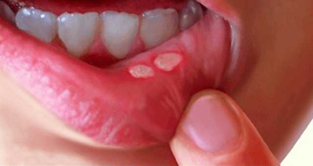 تعرف على أعراض الإصابة بمتلازمة بهجت