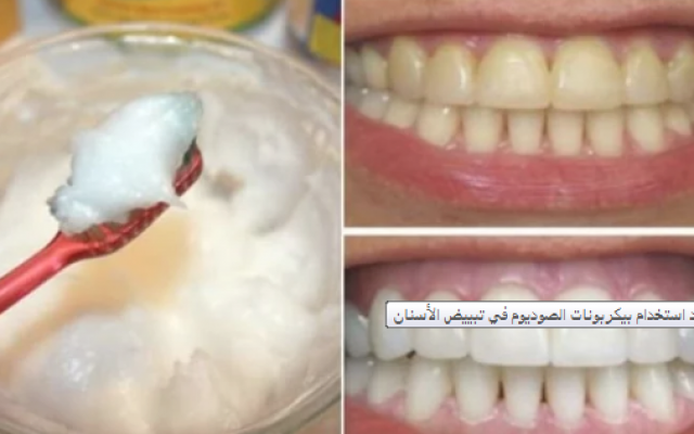 تبييض الاسنان