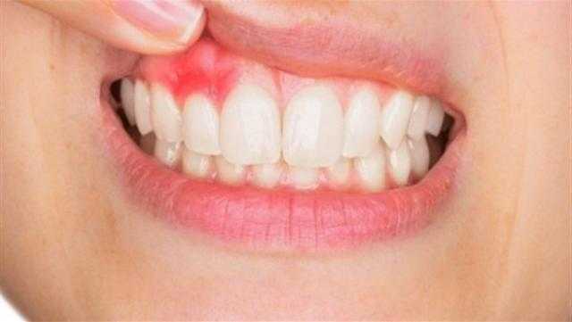 طرق طبيعية لعلاج ألم الأسنان واللثة