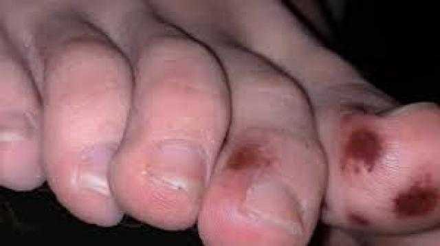 أصابع القدم.. أعراض جديدة للإصابة بفيروس كورونا