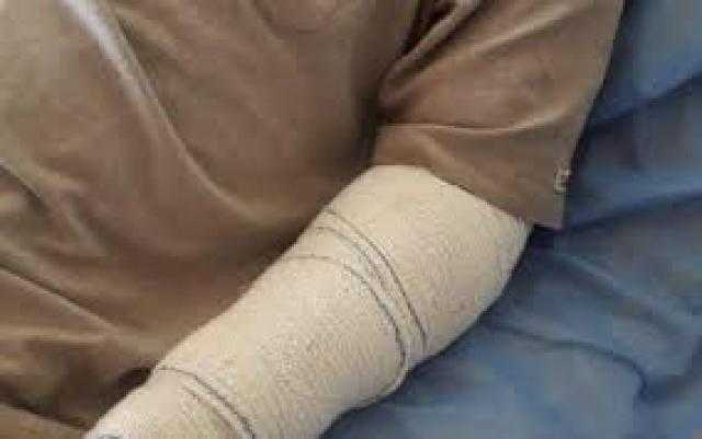 شوكة سمكة تتسبب في بتر ذراع شخص.. تفاصيل