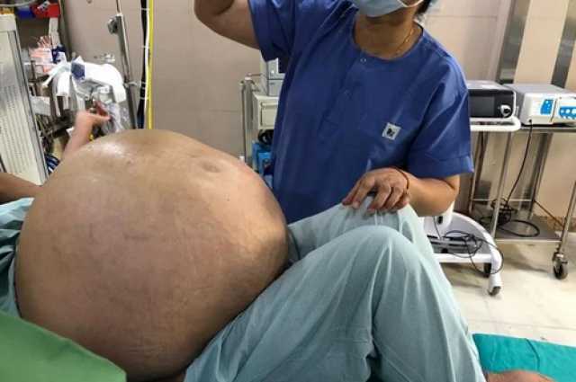 وزنه 50 كيلو.. استئصال أكبر ورم من رحم سيدة.. صور