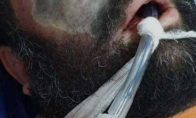 أستاذ كبد يحذر من الفطر الأسود: قد يؤدى إلى استئصال الفك والعينين.. فيديو