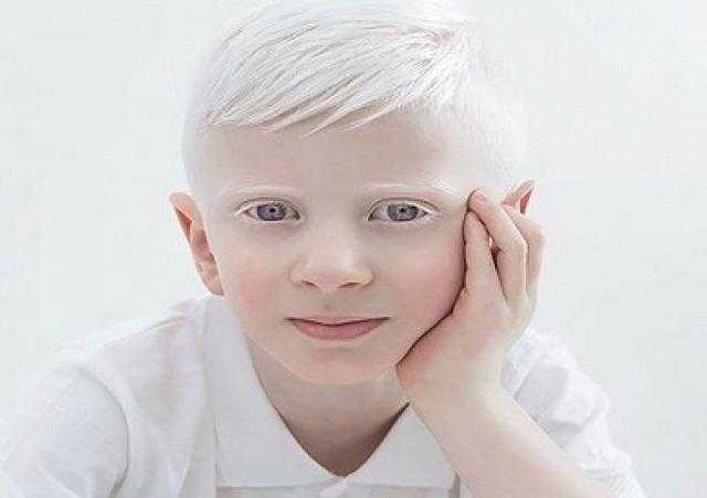 في اليوم العالمي للتوعية بالمهق.. دعوات أممية لوضع حد للتمييز ضد المصابين به