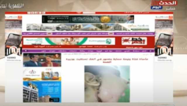 فتاة تعاني من ضمور بالفك تستغيث بوزيرة الصحة.. فيديو