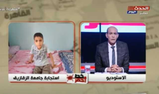 ”مستشفيات الزقازيق” تكشف تفاصيل علاج الطفل المصاب بحصوات في الكلى.. حالة نادرة (فيديو)