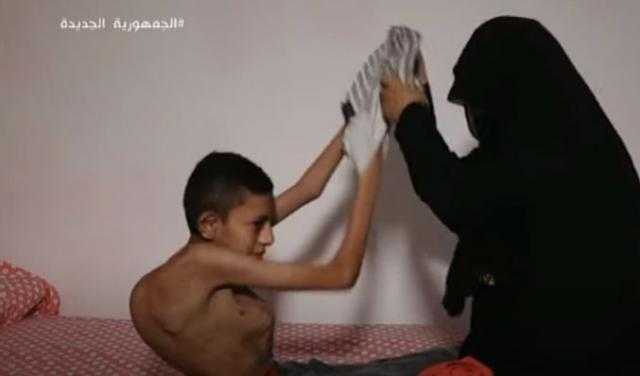 مأساة زياد.. يعاني من تحدب في الظهر ويحتاج جراحة بـ 250 ألف جنيه