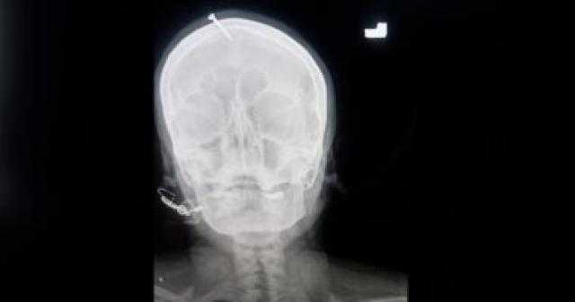 نقل امرأة هندية للمستشفى بعد غرسها مسمارا فى رأسها لضمان ولادة طفل ذكر