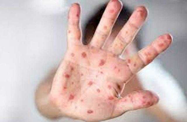 أكاديمية: هذه الفئة العمرية الأكثر عرضة للإصابة بجدري القرود.. فيديو