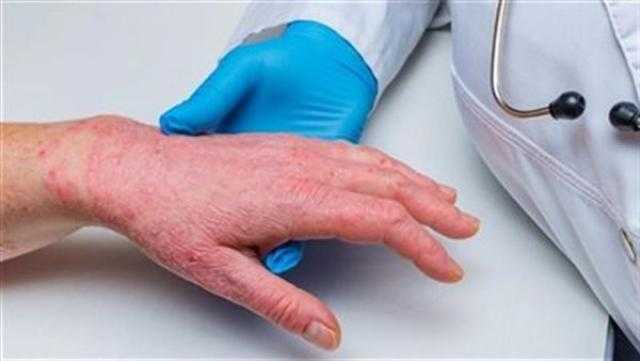 ألمانيا تعتزم الحصول على 400 ألف جرعة لقاح مضادة لجدري القرود