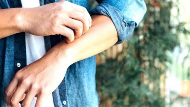ذا هيل: أمريكا تتعثر في استجابتها لجدري القردة