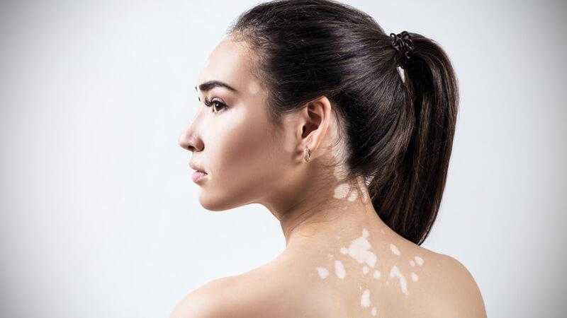 أول دواء منزلي لمرضى البهاق يعيد الجلد لطبيعته