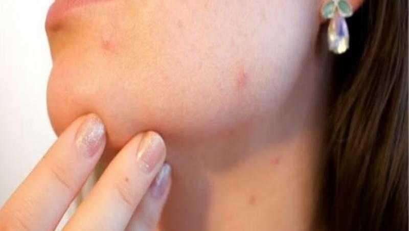 مسئولة بالصحة العالمية تكشف تفاصيل قرار طوارئ جدري القرود