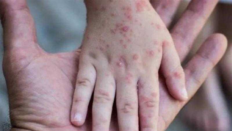 اليابان تعلن تسجيل أول إصابة بـ جدري القرود