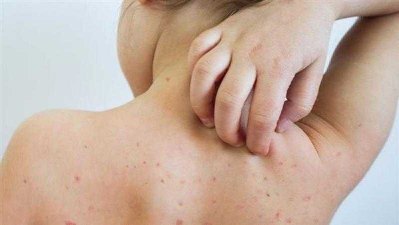 الفلبين تسجل أول إصابة بفيروس جدري القرود