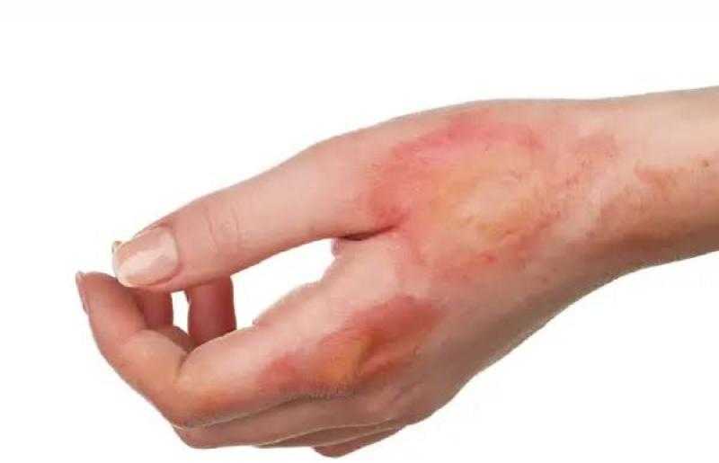 كيف تتصرف اذا تعرضت للحروق ؟ طبيب جلدية يجيب