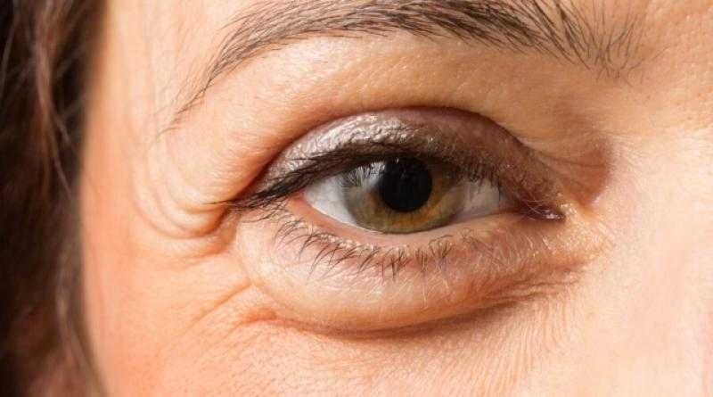 أسباب ظهور أكياس تحت العين