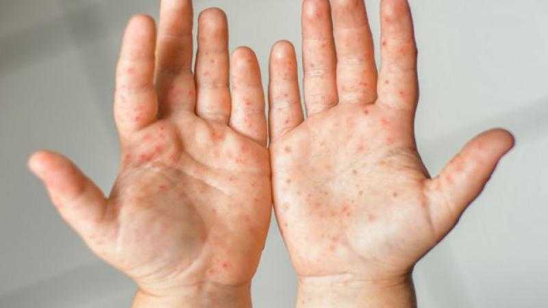 رصد أول إصابة بجدري الماء في اليمن