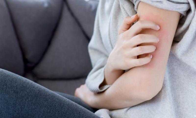 طرق طبيعية للتخلص من الجرب