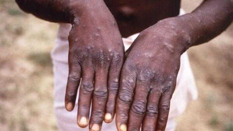 أول حالة وفاة بجدري القرود فى الولايات المتحدة