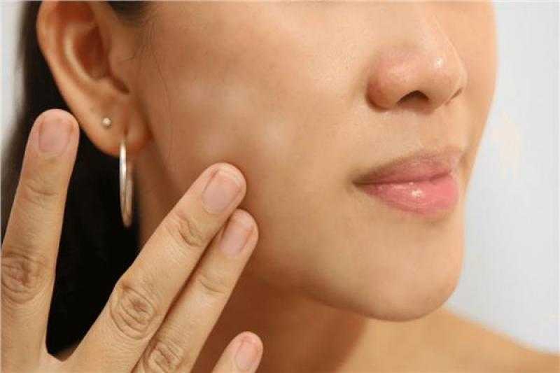 هل علاج البهاق بالليزر فعال أم لا ..استشارى أمراض جلدية تجيب