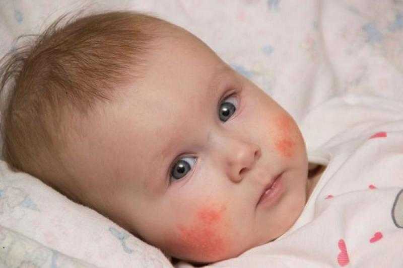 نصائح لعلاج حمو النيل والوقاية منه