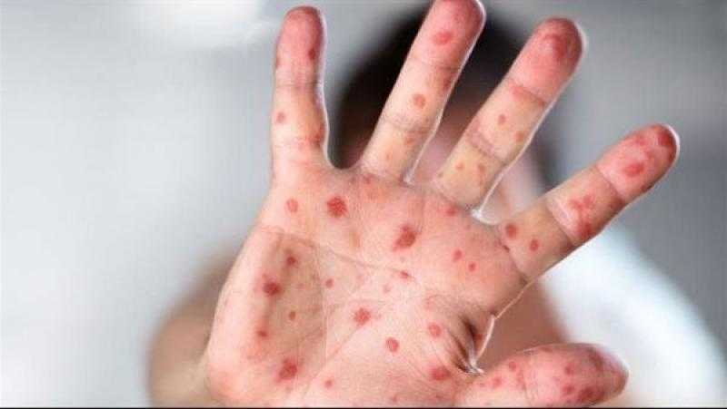 الصحة: يمكن الوقاية من جدري القرود ومعظم الحالات تتعافى