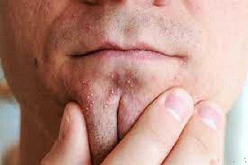 هل يظهر لديك حب الشباب فى منطقة الذقن ؟ إليك طرق العلاج