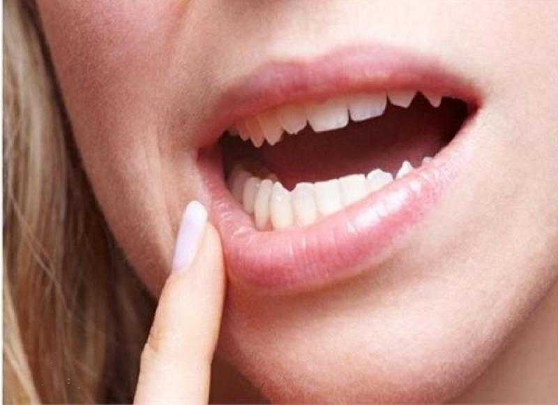 منها تورم الشفتين .. 6 علامات لسرطان الفم