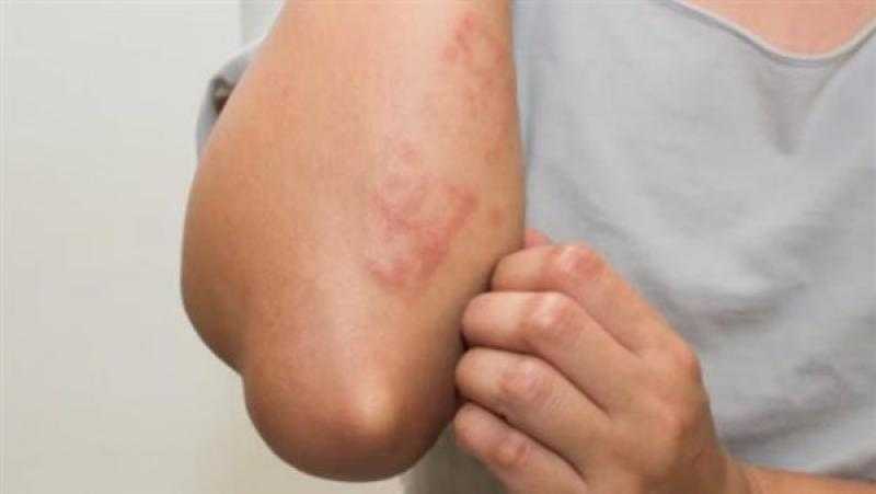 «الصحة» تؤكد ثبوت إصابة مريض وافد من دولة عربية بـ«جدري القرود»