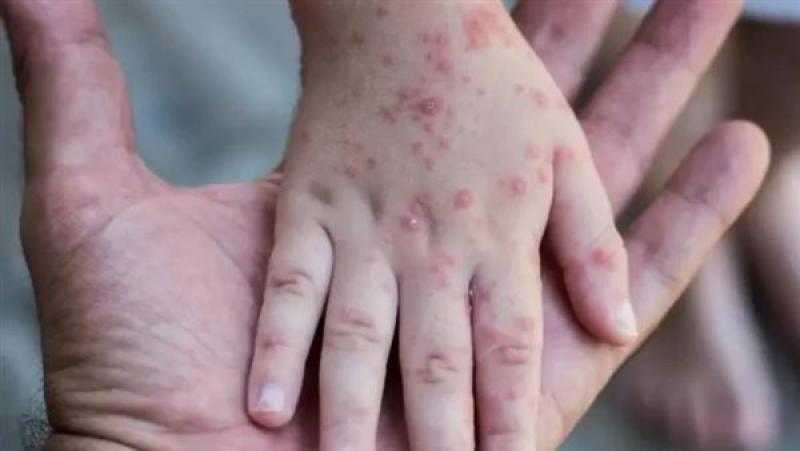 إصابات «جدري القردة» في الولايات المتحدة تتجاوز 25 ألف حالة
