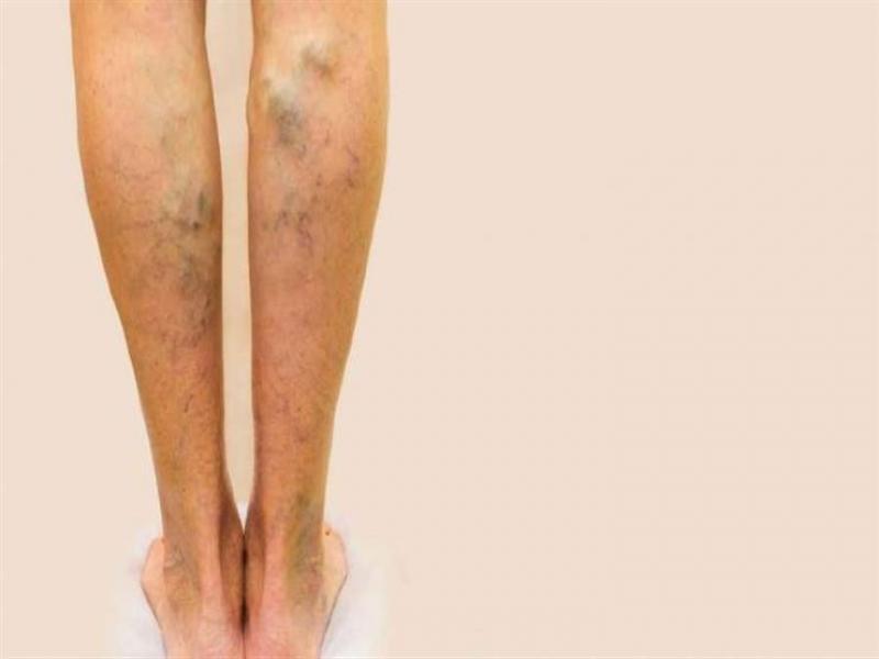 تعرف على أسباب ظهور دوالى الساقين