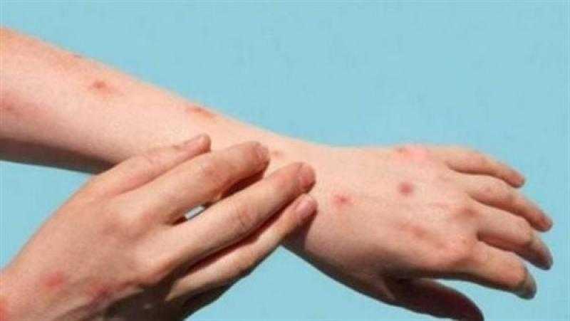 وزارة الصحة تعلن تسجيل إيجابية حالة إصابة بفيروس جدري القردة