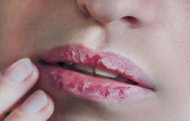 أسباب وعلاج تشقق الشفاه