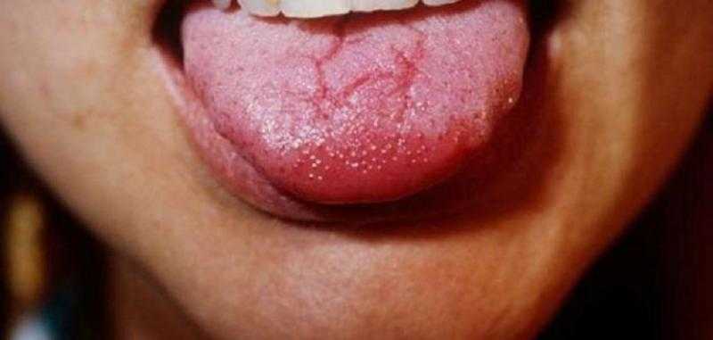 أعراض وطرق علاج تشقق اللسان