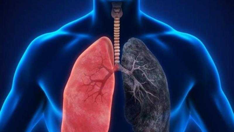 أسباب الإصابة بمرض الانسداد الرئوي المزمن.. إنفوجراف