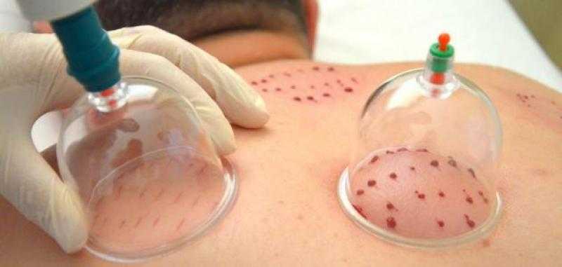 المفتي: الحجامة واردة في السنة النبوية ويجب إجراؤها على يد مختصين