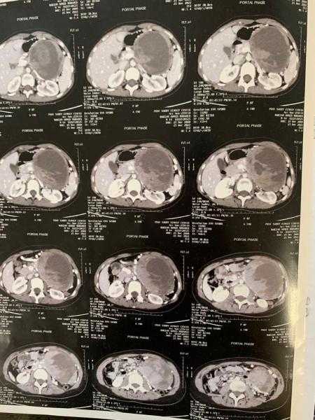 نجاح جراحة نادرة لإزالة ورم سرطاني متكيس في البنكرياس لطفلة بجامعة المنصورة