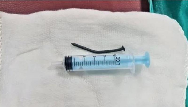 استخراج مسمار 6 سم من بطن طفل بالمنصورة: ”ابتلعه ووصل للإثنى عشر”