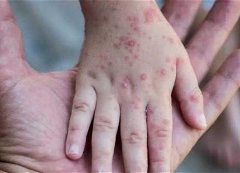 تسجيل إصابتين جديدتين بجدري القردة ..فى هذه الدولة