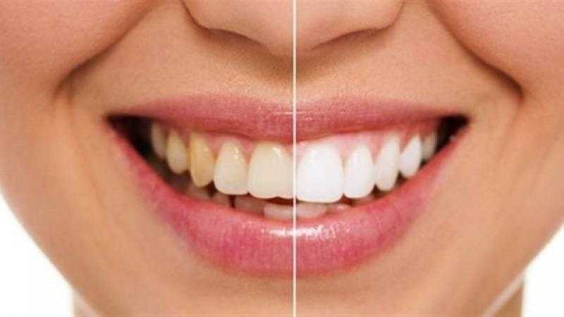 أطعمة ابتعد عن تناولها لحماية أسنانك من التسوس