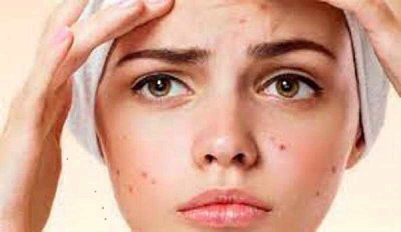 4 أسباب لظهور حب الشباب لدى البالغين