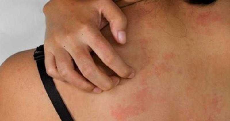 7 نصائح لتخفيف أعراض الطفح الجلدي الحراري لدى البالغين