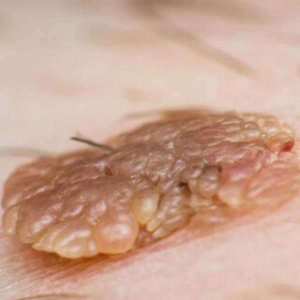 الصحة: لا يمكن انتقال عدوى فيروس HPV من خلال إزالة الشعر بالليزرعند الجنسين